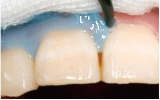 TiON治療の流れ4