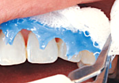 TiON治療の流れ8